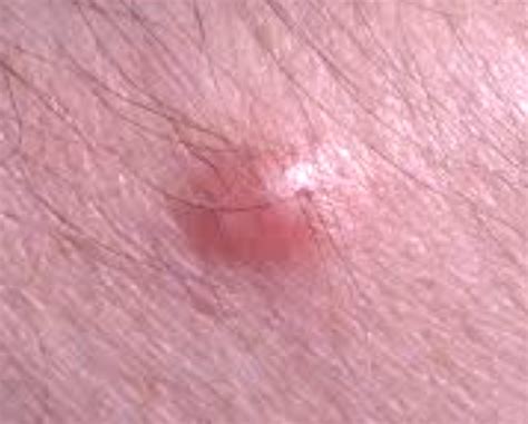 Dermatofibroma - Pictures, Removal, Symptoms, Causes, Treatment