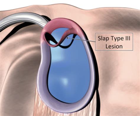 Everything You Need to Know About SLAP Lesion of the Shoulder