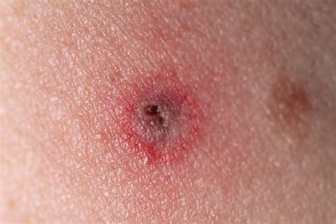 Tick Bite Pictures & Symptoms - What Does a Tick Bite Look Like?