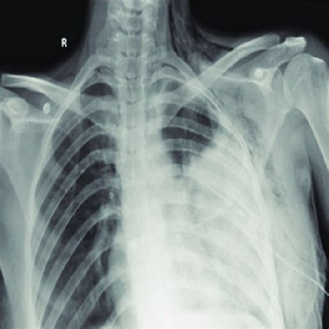 Summary of Studies Examining Complications Following Thoracentesis in ...