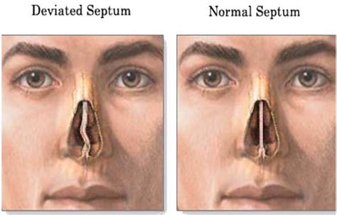 Deviated Nasal Septum Treatment - Septoplasty Surgery Cost | Venkat ...