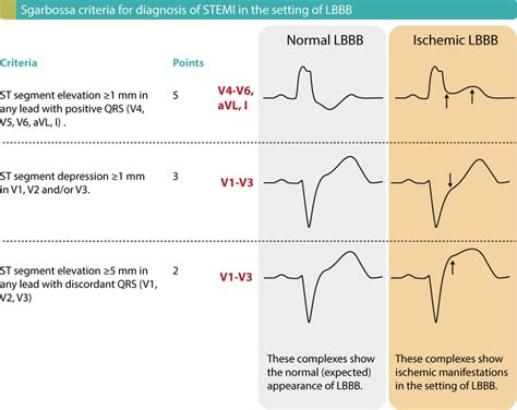 Left bundle branch block (LBBB) in acute myocardial infarction: the Sgarbossa criteria – ECG ...