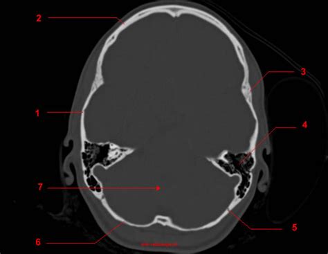 Skull CT anatomy - W-Radiology