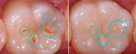 Tooth Colored Fillings & Fissure Sealants – Malaga Dental Clinic