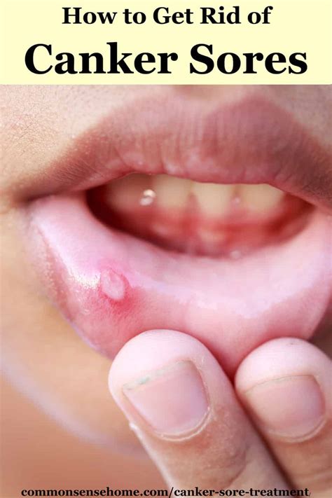 Canker Sore Treatment (How to Get Rid of Canker Sores)