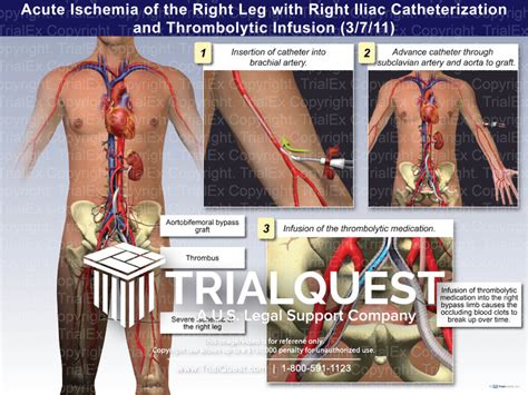 Acute Ischemia of the Right Leg with Right Iliac Catheterization and Thrombolytic Infusion ...