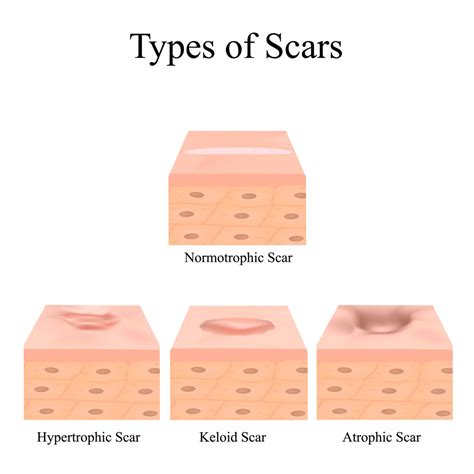 Acne Scar Removal Costs, Average Prices of Acne Scar Treatment Options 2021