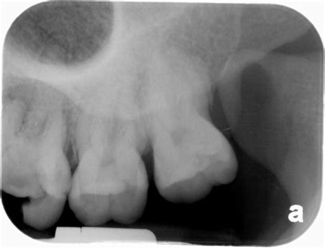 Anatomy Monday: Coronoid Process (mandible) – Dr. G's Toothpix