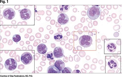 Close-up on abnormal monocyte morphology in peripheral blood smears - CAP TODAY