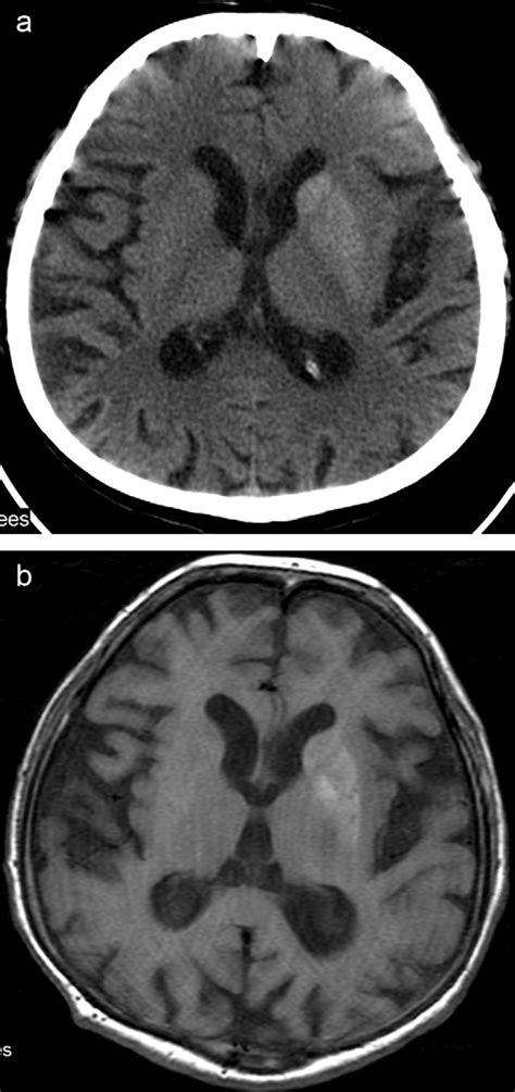 Hemichorea/hemiballism. 71-year-old woman with involuntary... | Download Scientific Diagram