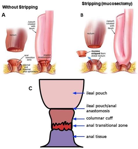 Proctocolectomy With J Pouch