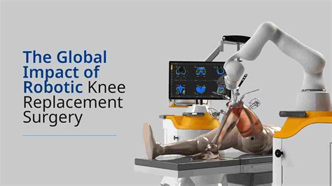 Robotic assisted knee replacement surgery