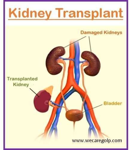 Kidney Transplant (Renal Transplant) - We Care