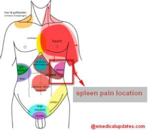 Spleen Pain - Location, Function, Enlarged and Ruptured spleen