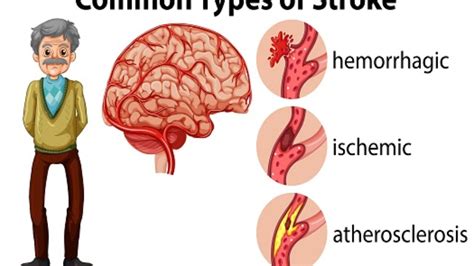 Brain Stroke: Types, Causes, Symptoms, Prevention And, 60% OFF