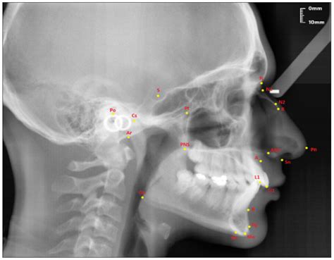 Diagnostics | Free Full-Text | Investigation of the Relationship between Sagittal Skeletal Nasal ...