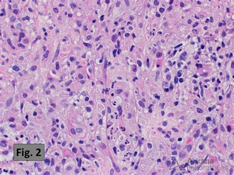 Malakoplakia | Teaching Points | Arkana Laboratories