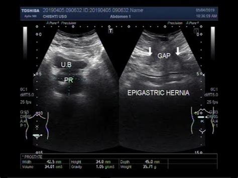 Ultrasound Video showing Epigastric Hernia - YouTube