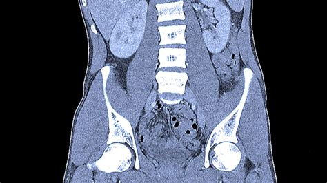 black spots on ct scan of abdomen and pelvis