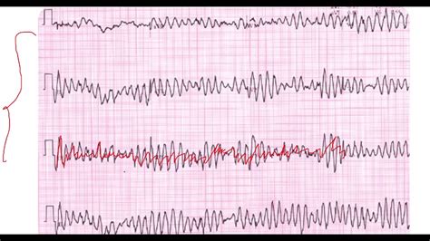 Fibrilación Ventricular vs Torsades de pointes EKG - YouTube