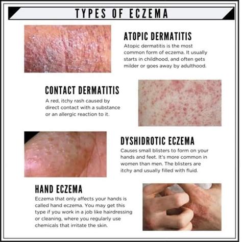 WHAT IS ECZEMA? Eczema is a... - Fazeel Homeopathic Clinic