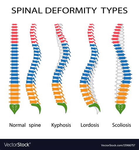 Spinal deformity types Royalty Free Vector Image