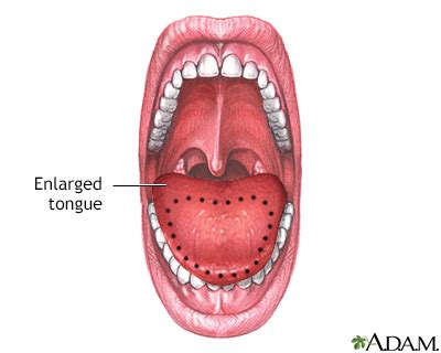 Macroglossia