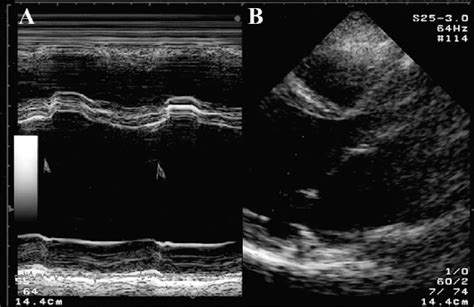 Echocardiography at the age of 27. (1997.1.24) (Panel A) M-mode, (Panel...