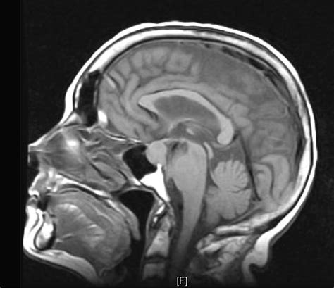 Hemorrhage From a Pituitary Macroadenoma After a Minor Trauma | Walid ...