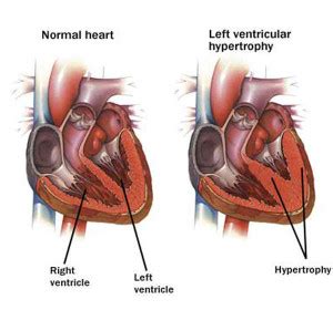 » Left Ventricular Hypertrophy