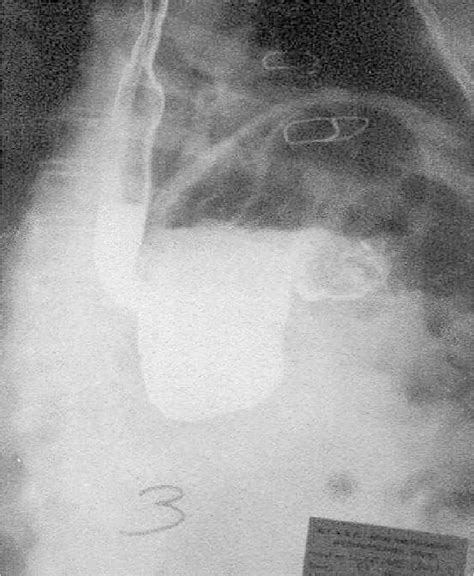 Figure 1 from The management of acute gastric volvulus. | Semantic Scholar