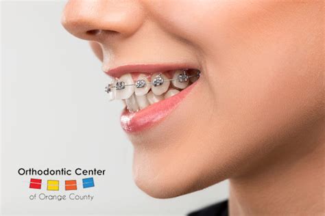 Orthodontists and Braces in OC | Braces on Crooked Teeth