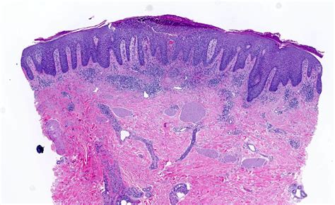 Guttate Psoriasis Histology