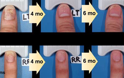 Psoriasis treatment: Phototherapy