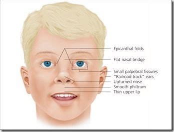 7 Fetal Alcohol Syndrome ideas | fetal alcohol syndrome, fetal alcohol ...