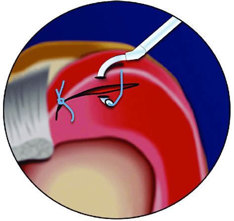 Suture repair of a posterior medial meniscus tear with a hook... | Download Scientific Diagram