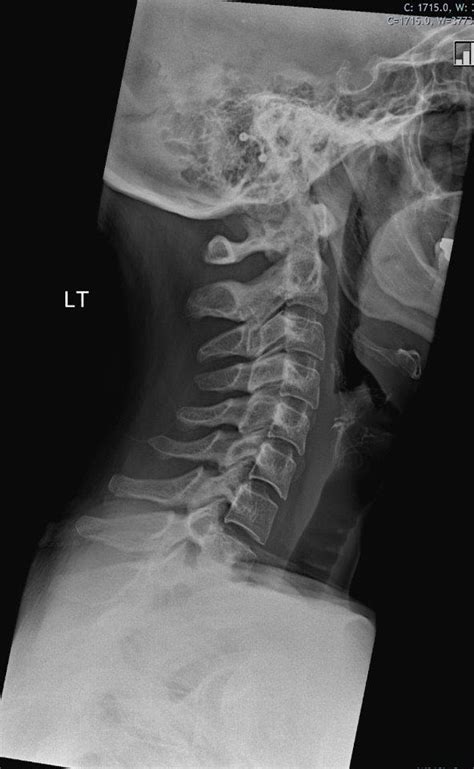 Healthy Cervical Spine Xray