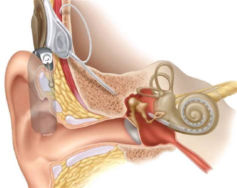 Cochlear Implants | Dr Sean Flanagan