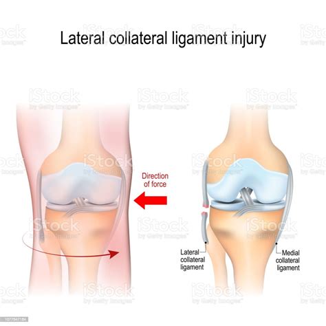 Fibular Collateral Ligament Injury Stock Illustration - Download Image ...