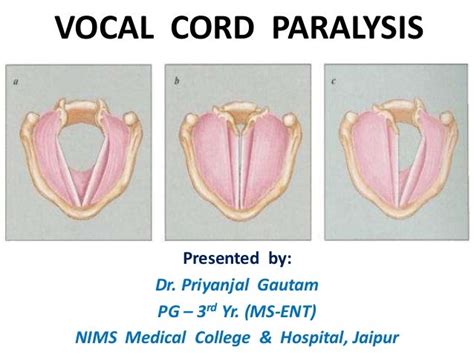 Vocal cord paralysis