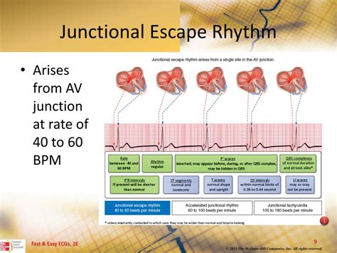 PPT - Junctional Dysrhythmias PowerPoint Presentation, free download ...