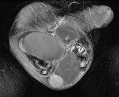 Scrotal masses MRI - wikidoc