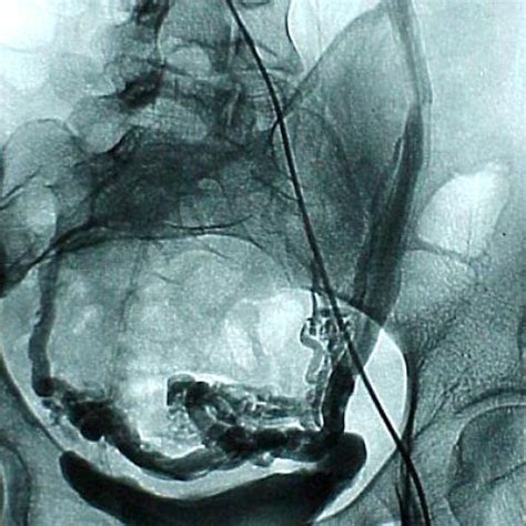 An ovarian varicocele. Gonadal vein venography and embolisation. | Eurorad