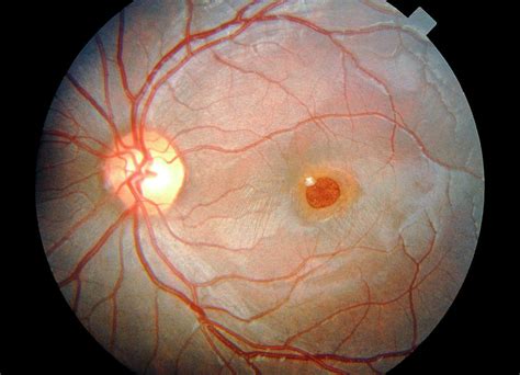 Ophthalmoscopy Of Retinopathy Caused By Sunlight Photograph by Sue Ford ...