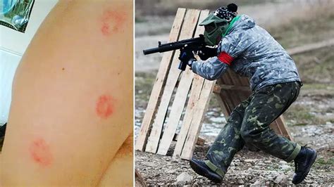 How to Treat & Prevent Paintball Bruises and Welts 2024