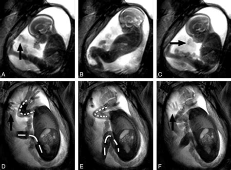 Different Types of Fetal Movement Explained - BaileykruwHammond