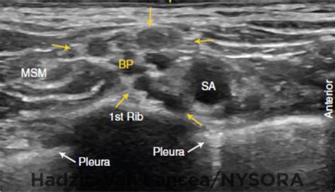 Ultrasound-Guided Supraclavicular Brachial Plexus Block - NYSORA The New York School of Regional ...