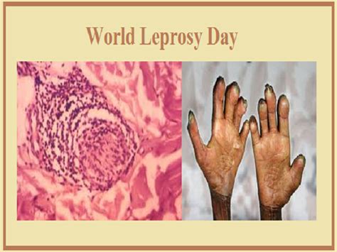 World Leprosy Day 2023: Know about Theme, History, Significance ...