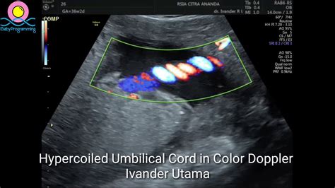 Hypercoiled Umbilical Cord - YouTube