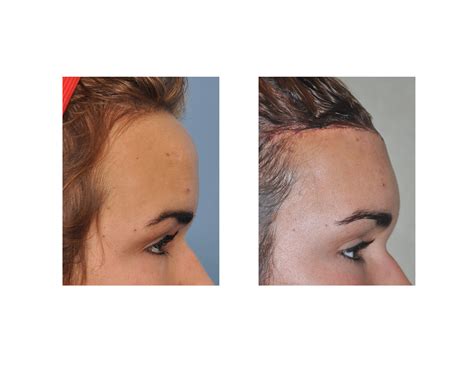 Case Study: Reduction of the Long Forehead and Frontal Bossing - Explore Plastic Surgery